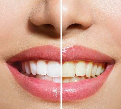 روش های خانگی سفید کردن دندان | رهایی از دندان های زرد و سفید شدن سریع دندان