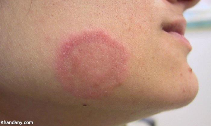 9 عفونت شایع پوست با منشا باکتری