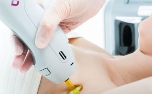 Laser Hair Removal Vancouver - First Ave Medical Spa Kitsilano