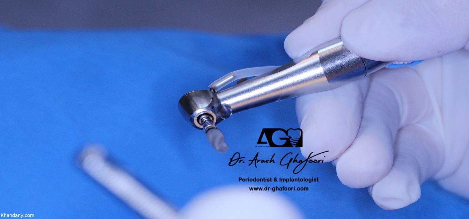 کاشت ایمپلنت دندان