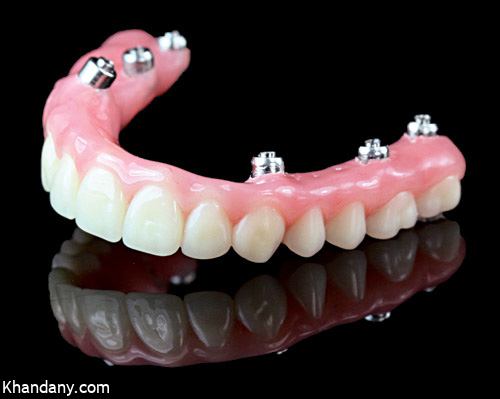 دندان مصنوعی ثابت