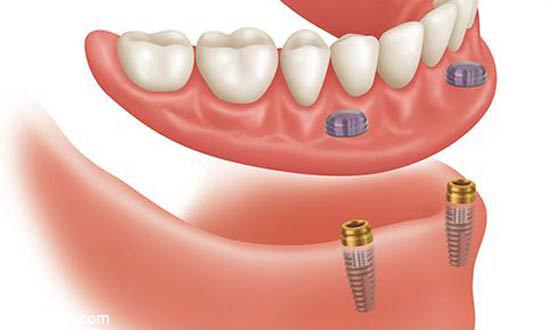 ایمپلنت دندان مصنوعی ثابت