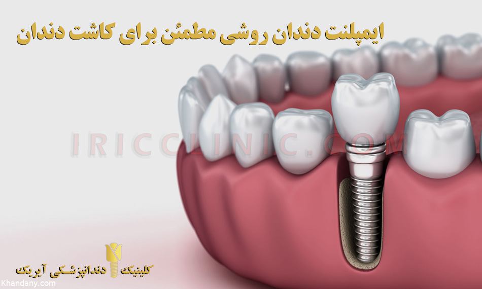 بررسی ایمپلنت دندان و درد ایمپلنت