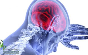 درمان سکته مغزی