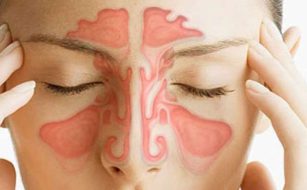 از کجا بفهمیم پولیپ بینی داریم؟