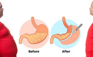 بای پس معده
