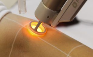 لیزر پوست مرغی