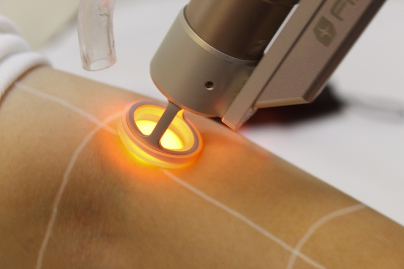 لیزر پوست مرغی